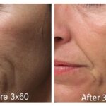Nowadays the CO2 Laser is a therapeutic tool in numerous facial rejuvenation techniques both non invasive and minimally invasive. scaled