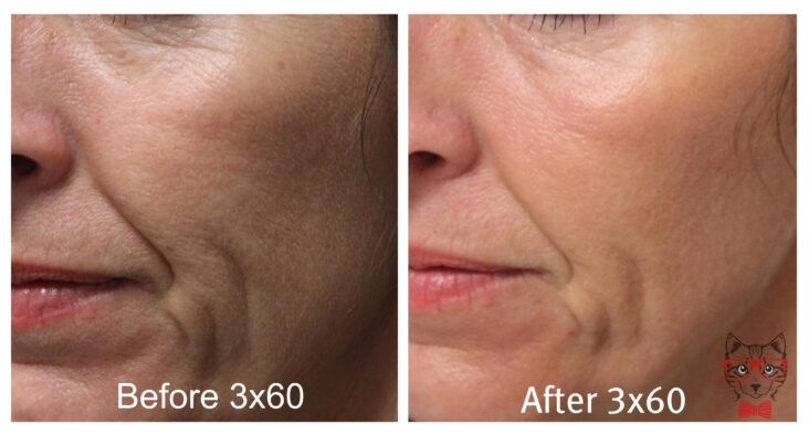 Nowadays the CO2 Laser is a therapeutic tool in numerous facial rejuvenation techniques both non invasive and minimally invasive. scaled