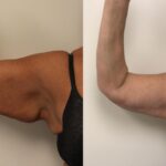 arm lift brachioplasty 70 front detail