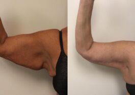 arm lift brachioplasty 70 front detail