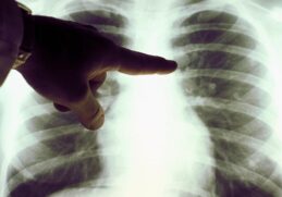 Recovered Covid 19 patients lose up to 30 lung capacity