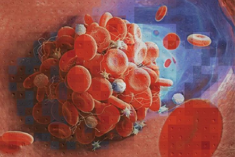 World Thrombosis Day: Why Blood Clots Are An Urgent Global Public Health Problem World Thrombosis Day: Why Blood Clots Are An Urgent Global Public Health Problem