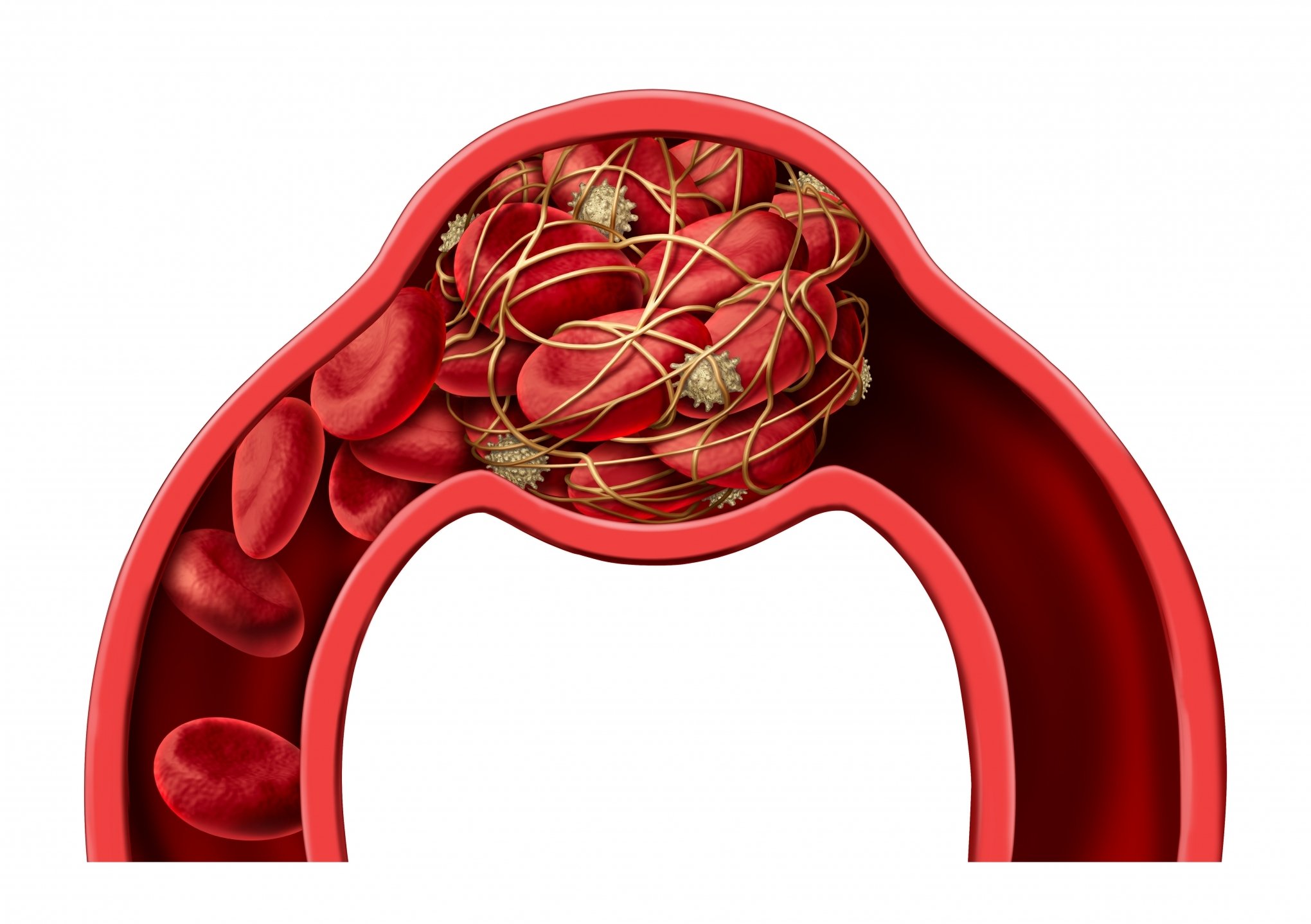 World Thrombosis Day: Why Blood Clots Are An Urgent Global Public Health Problem World Thrombosis Day: Why Blood Clots Are An Urgent Global Public Health Problem