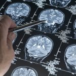 Severe COVID and Alzheimer's: Investigating Similar Effects on Cognitive Decline