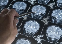 Severe COVID and Alzheimer's: Investigating Similar Effects on Cognitive Decline
