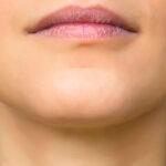 Implants for the Chin Cheek and Jaw