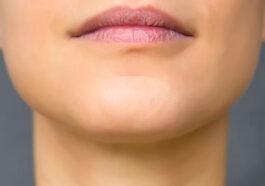 Implants for the Chin Cheek and Jaw