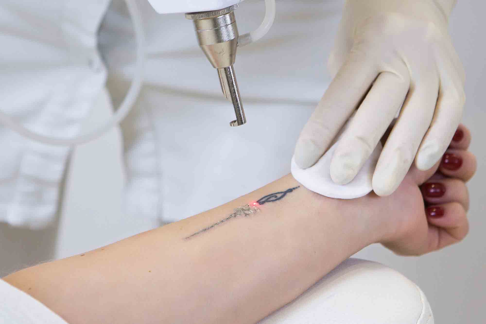 PhiRemoval for Tattoo Removal