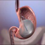 Everything you need to know about - Pose method vs Intragastric Balloon 4609 3419