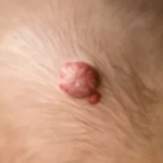 648x364 Hemangioma of Skin