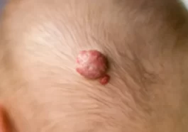 648x364 Hemangioma of Skin