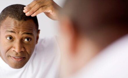 Alopecia and nutrition
