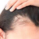 Androgenetic Alopecia Treatments Hair life cycle