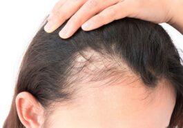 Androgenetic Alopecia Treatments Hair life cycle