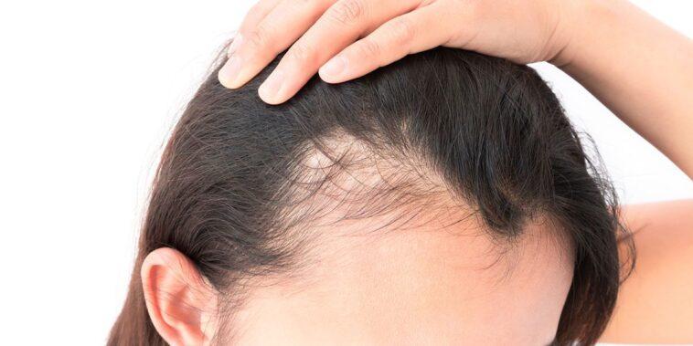 Androgenetic Alopecia & Treatments Hair life cycle Androgenetic Alopecia Treatments Hair life cycle