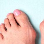 Secret Bridge: the new technique to treat bunions Best Treatment for Bunions