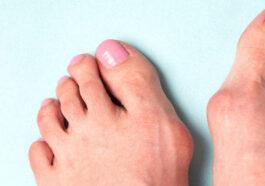 Best Treatment for Bunions