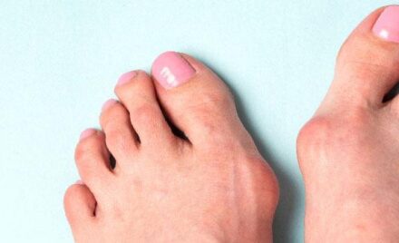 Best Treatment for Bunions