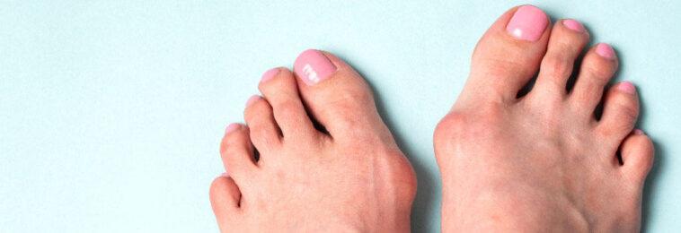 Secret Bridge: the new technique to treat bunions Best Treatment for Bunions