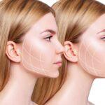 Laser bichectomy, a defined face CHINANDJAWLINE 1024x668 1