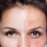 Dermamelan to heal the skin even in summer