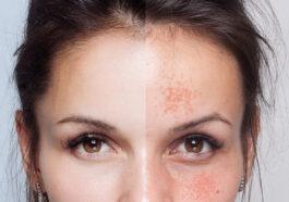 Dermamelan to heal the skin even in summer