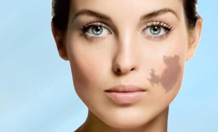 Eliminate birthmarks with the revolutionary RevLite® laser