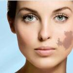 Eliminate birthmarks with the revolutionary RevLite® laser