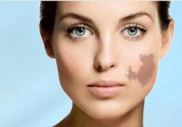 Eliminate birthmarks with the revolutionary RevLite® laser