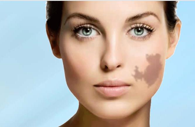 Eliminate birthmarks with the revolutionary RevLite® laser