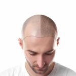9 Most Common Questions About Hair Transplantation Answered Follicular Unit Extraction