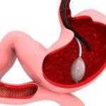 Gastric Balloon Pill An Innovation With Proven Results