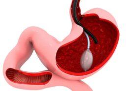 Gastric Balloon Pill An Innovation With Proven Results
