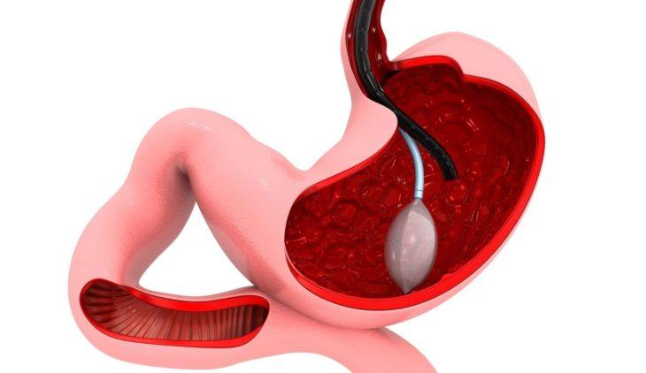 Gastric Balloon Pill: An Innovation With Proven Results Gastric Balloon Pill An Innovation With Proven Results