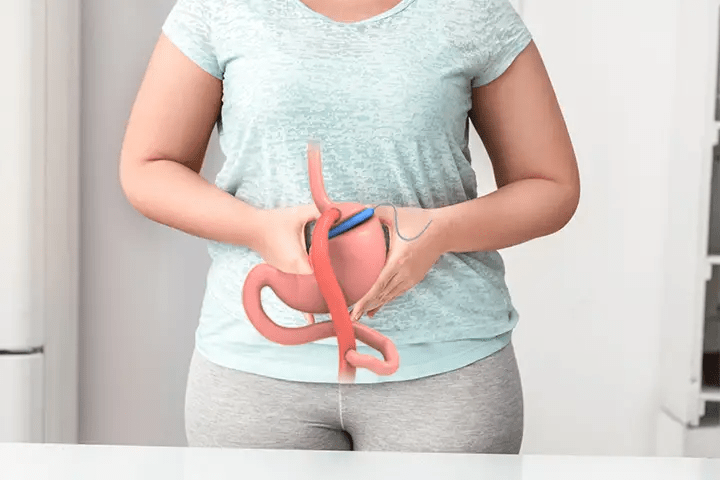 Gastric Bypass: diatetic guidelines in the postoperative period Gastric Bypass diatetic guidelines in the postoperative period