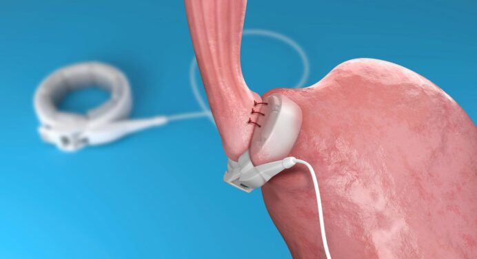 Gastric band