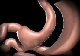 Gastric sleeve