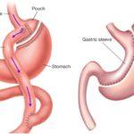 Gastric sleeve and gastric bypass dietary and nutritional aspects