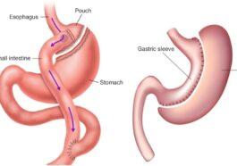 Gastric sleeve and gastric bypass dietary and nutritional aspects