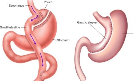 Gastric sleeve and gastric bypass dietary and nutritional aspects