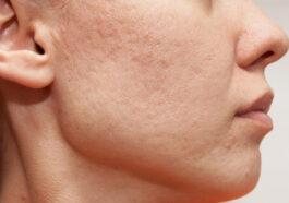 How to treat blemishes on the face hands and decollete