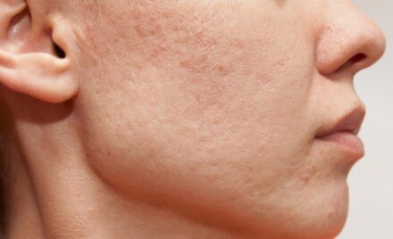 How to treat blemishes on the face hands and decollete
