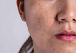 Hyperpigmentation of the upper lip causes and remedies