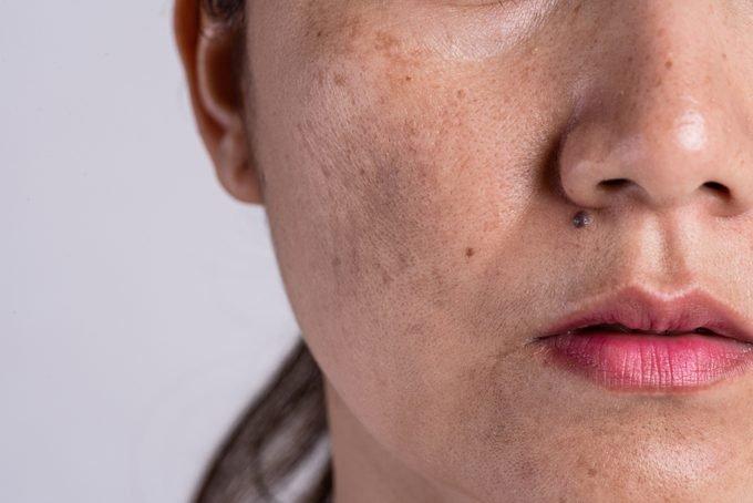 Hyperpigmentation of the upper lip causes and remedies