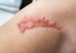 Hypertrophic and Keloid Scarring