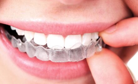 Invisalign