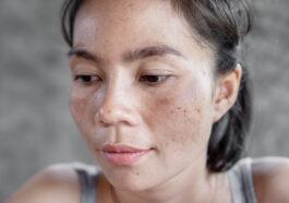 Melasmas hormonal spots caused by the sun
