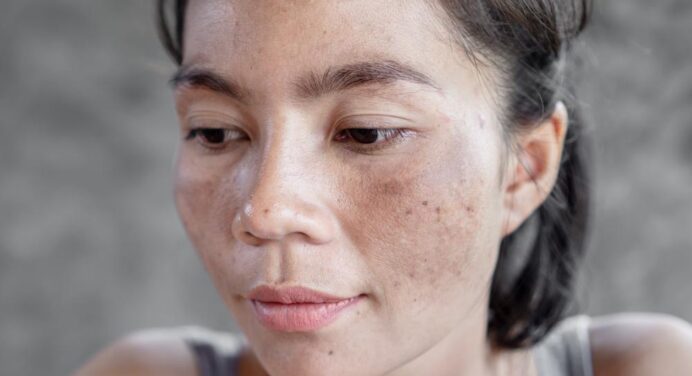 Melasmas: hormonal spots caused by the sun