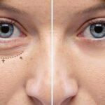 Non surgical Blepharoplasty what is it and how does it works