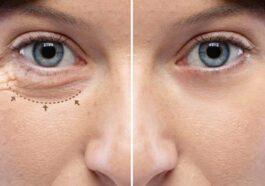 Non surgical Blepharoplasty what is it and how does it works